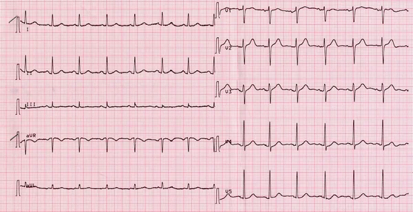 EKG av hjärtrytm — Stockfoto