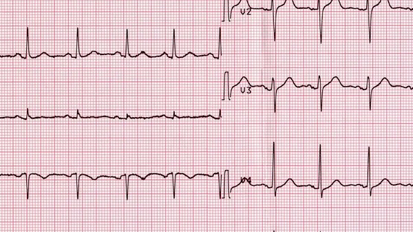 Électrocardiographie du rythme cardiaque — Photo