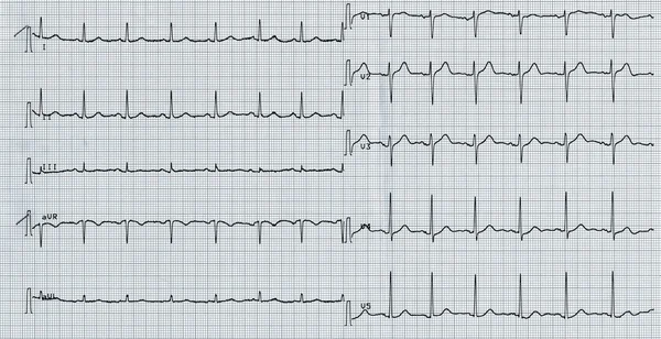 Eletrocardiografia do batimento cardíaco — Fotografia de Stock