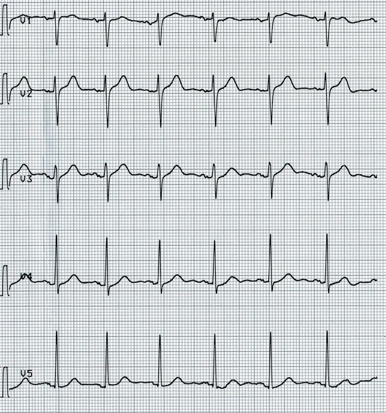 Eletrocardiografia do batimento cardíaco — Fotografia de Stock