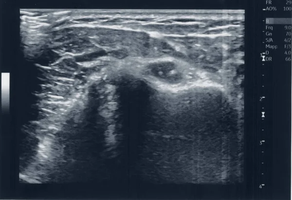 Usg Mięśni Ścięgna Medycznego Aka Ultrasonografia — Zdjęcie stockowe