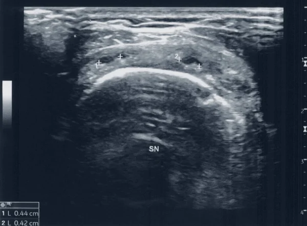 Medical Tendon Muscle Ultrasound Sonography Aka Ultrasonography — Stock Photo, Image