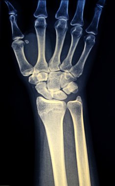 insan elinin x-ray görüntüsü