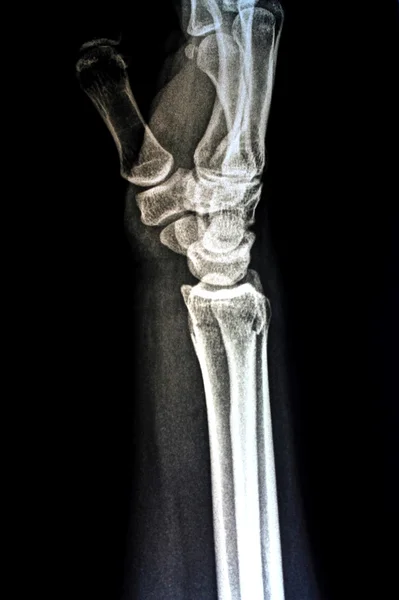 Рентгенівське зображення рук людини — стокове фото