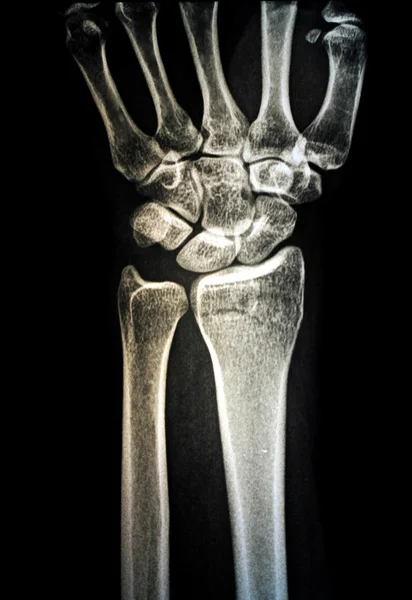 Insan elinin x-ray görüntüsü — Stok fotoğraf