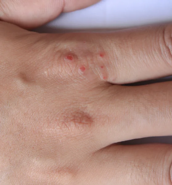 Inflammation of the skin on hands dry skin rash and itching