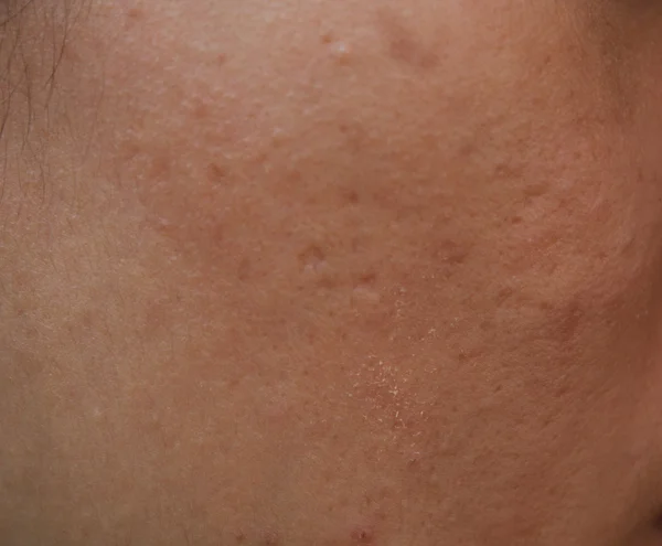 Femme à la peau grasse et cicatrices d'acné — Photo