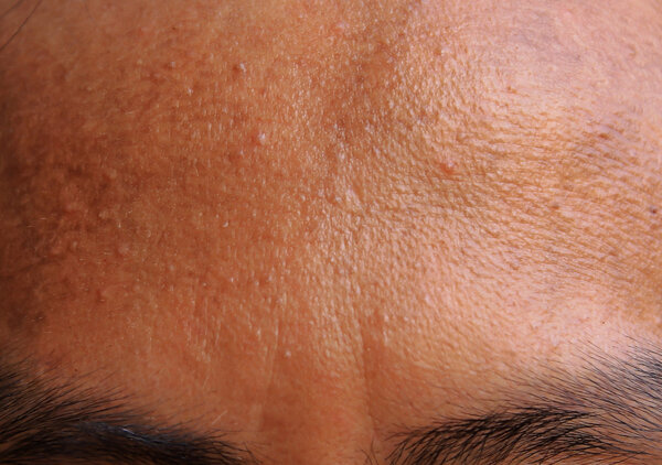 acne forehead 