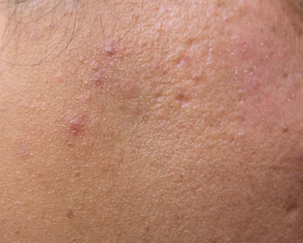 Donna con pelle grassa e cicatrici da acne — Foto Stock