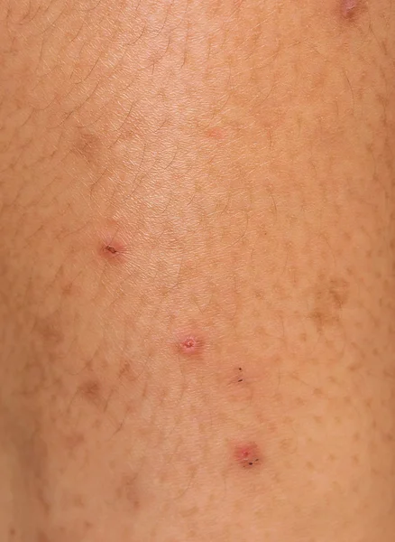 脚にアレルギー性の発疹 — ストック写真