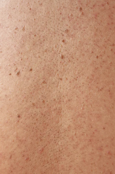 Menina com cicatrizes problemáticas de pele e acne nas costas — Fotografia de Stock