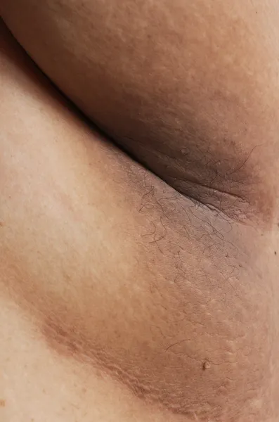 problem of the skin on the armpits and hair