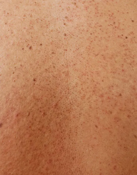 Meisje met problematische huid en acne littekens in de rug — Stockfoto