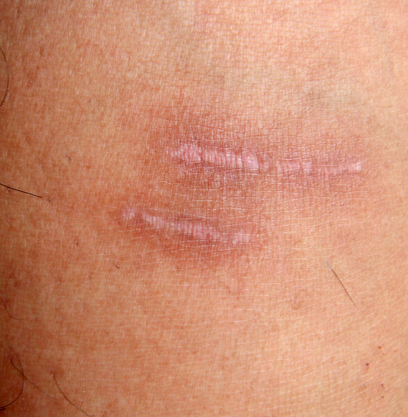 A burn scar that is partly healed
