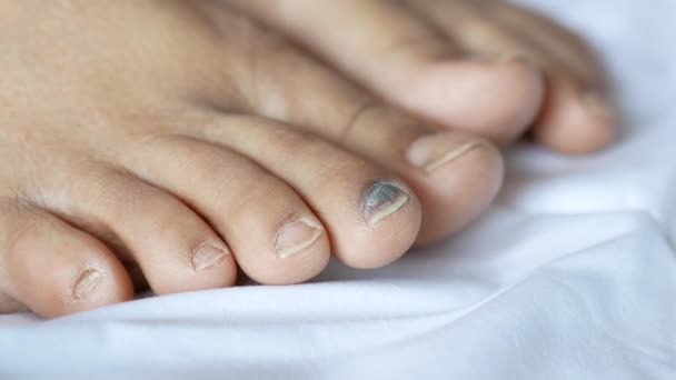 Närbild av kvinnor infekterade fötter fingrar på sängen , — Stockvideo
