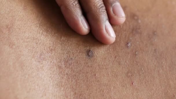 Menutup dari anak muda menderita masalah kulit . — Stok Video