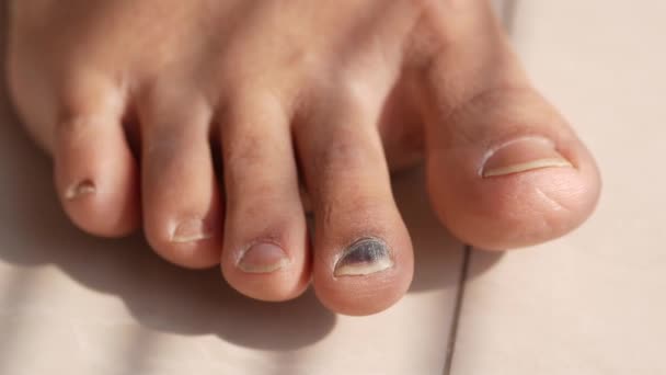 Gros plan de femmes infectées pieds doigts sur le lit , — Video