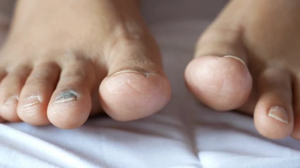 Primer plano de las mujeres pies infectados dedos en la cama , — Vídeo de stock
