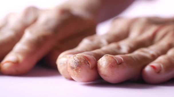 La mano de las mujeres mayores con la piel infectada y seca — Vídeos de Stock