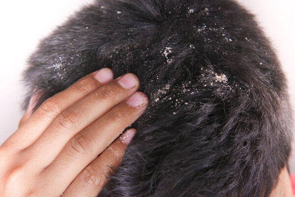 men with dandruff in his hair, closeup 