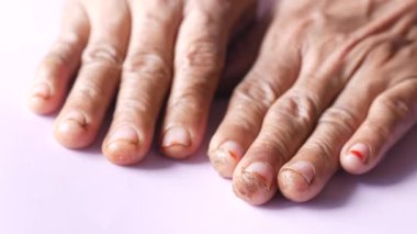 Enfeksiyon kapmış ve kuru ciltli yaşlı kadınların eli