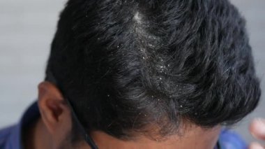 Saçında kepek olan adamlar, yakın plan. 
