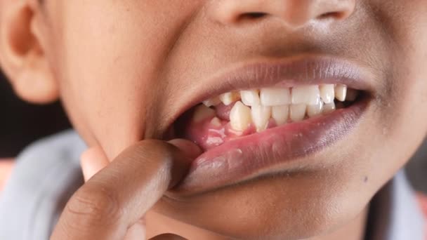 Kid smiling with deformed teeth close up — Wideo stockowe