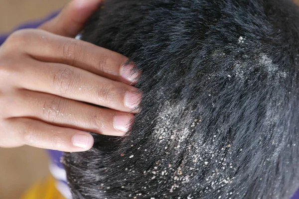 Men with dandruff in his hair, closeup — Stock Photo, Image