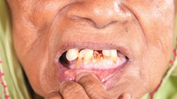 Donna Anziana Sorridente Con Denti Deformati — Video Stock