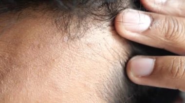 Saç dökülmesi konsepti. .