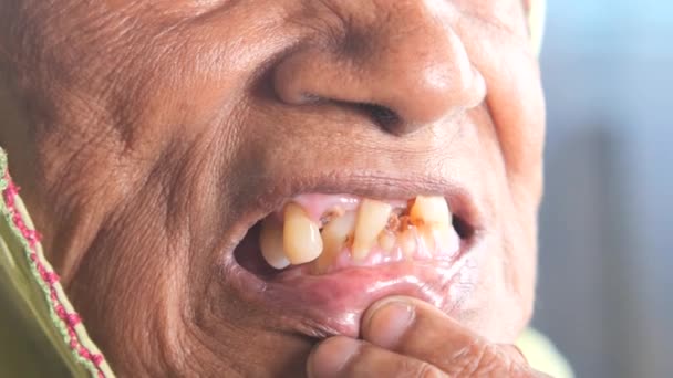 Primo Piano Delle Donne Anziane Carie Dentale Alcuni Denti Rotti — Video Stock