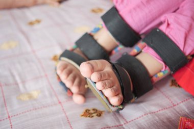 Çocuk serebral felç, bacak ortozu.