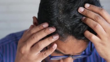 Saçında kepek olan adamlar, yakın plan. .