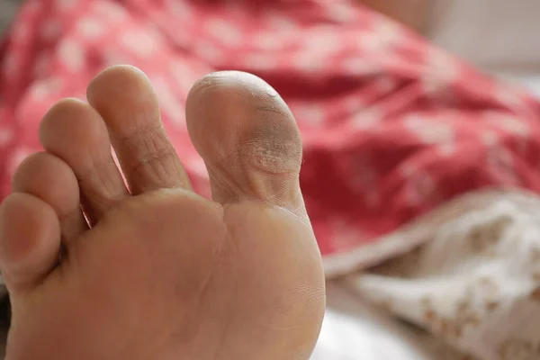 Крупним Планом Молоді Чоловіки Сухі Ноги Ліжку — стокове фото
