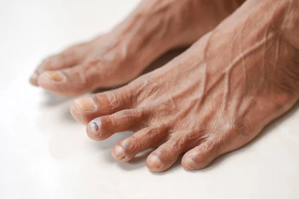 Close Senior Vrouwen Voeten Hand Massage Letsel Plek — Stockfoto