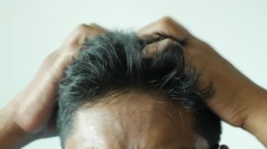 Saçında kepek olan adamlar, yakın plan. .