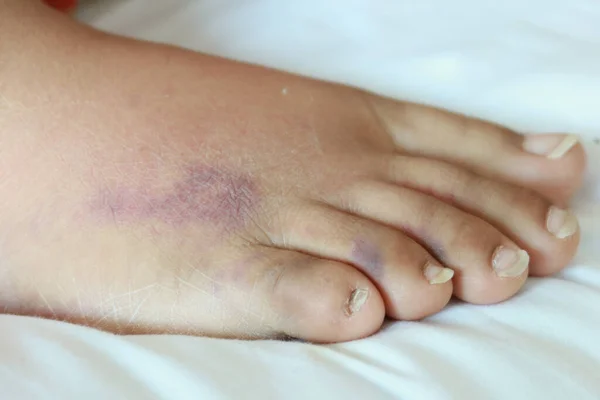 Κλείσιμο Των Γυναικών Πόδια Πρήξιμο Στο Κρεβάτι — Φωτογραφία Αρχείου