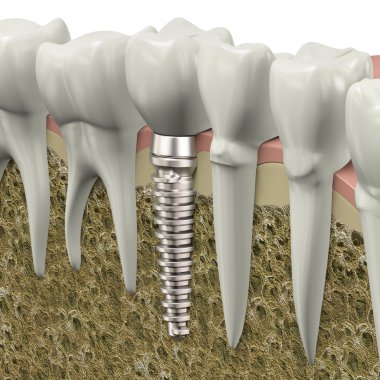 diş implantı