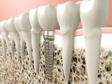 diş implantı