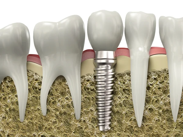 Zubní implantát — Stock fotografie