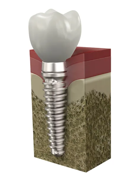 Dental implant — Stock Photo, Image