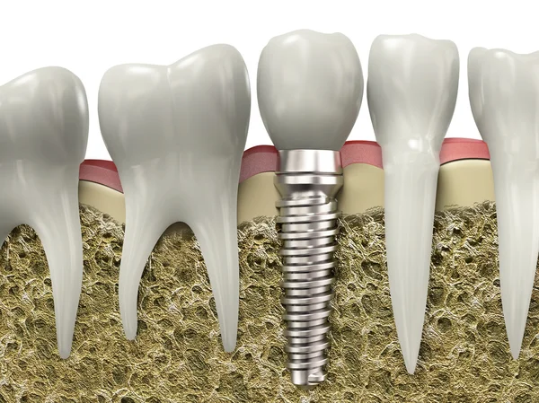 Implante dental Imágenes de stock libres de derechos