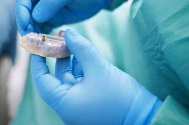 Diş hekimi elleri diş implantı olan bir model tutuyor.