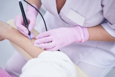 Deneyimli Kafkas güzellik kliniği doktoru kadın kolunda nevus çıkarıyor.