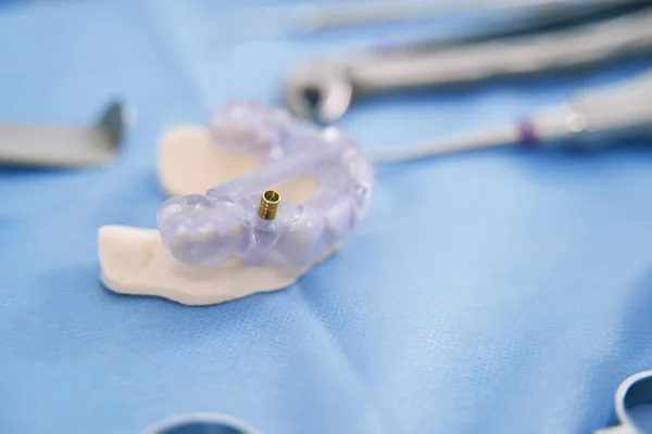 歯のクリニックで金属インプラントと歯のモデル — ストック写真