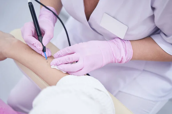 Médico de clínica de beleza caucasiano experiente removendo nevo no braço feminino — Fotografia de Stock