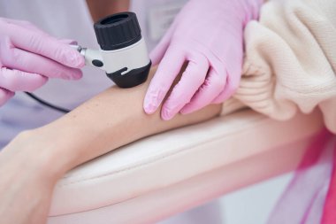 Azot eldivenli doktor dermoskop ile hasta cildini kontrol ediyor.