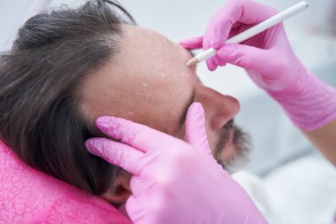 Kozmetik uzmanı, gençleştirme enjeksiyonundan önce erkek müşterinin alnında izler bırakıyor.