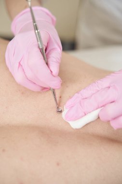 Pembe eldivenli güzellik salonu çalışanı tek kaşık ve ped ile hastanın cilt gözeneklerini tedavi ediyor.