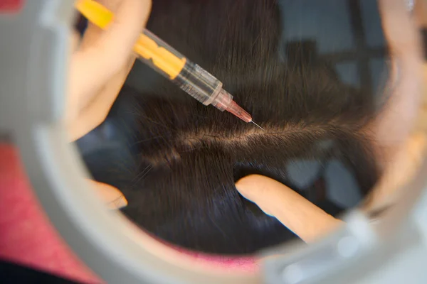 Лікар Робить Єкцію Шприцом Засобом Поліпшення Росту Волосся Проти Облисіння — стокове фото